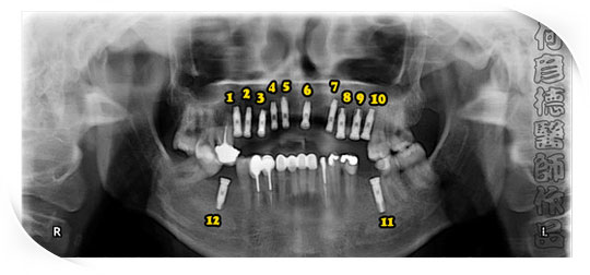 徐先生 植牙完成後的全口 X 光片 (共植12顆)