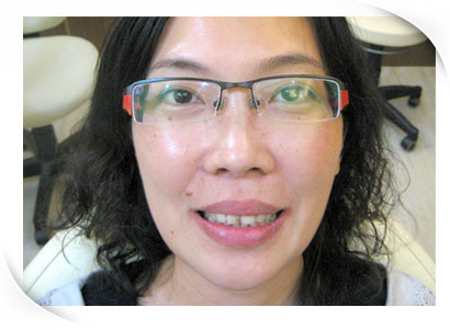 植牙專科醫師 Dr.何彥德- 3D水雷射微創人工植牙